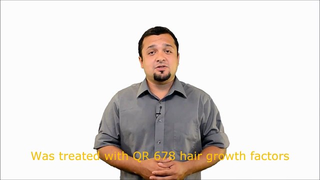 Best Male Pattern Alopecia Treatment in Mumbai, India- Dr. Debraj Shome