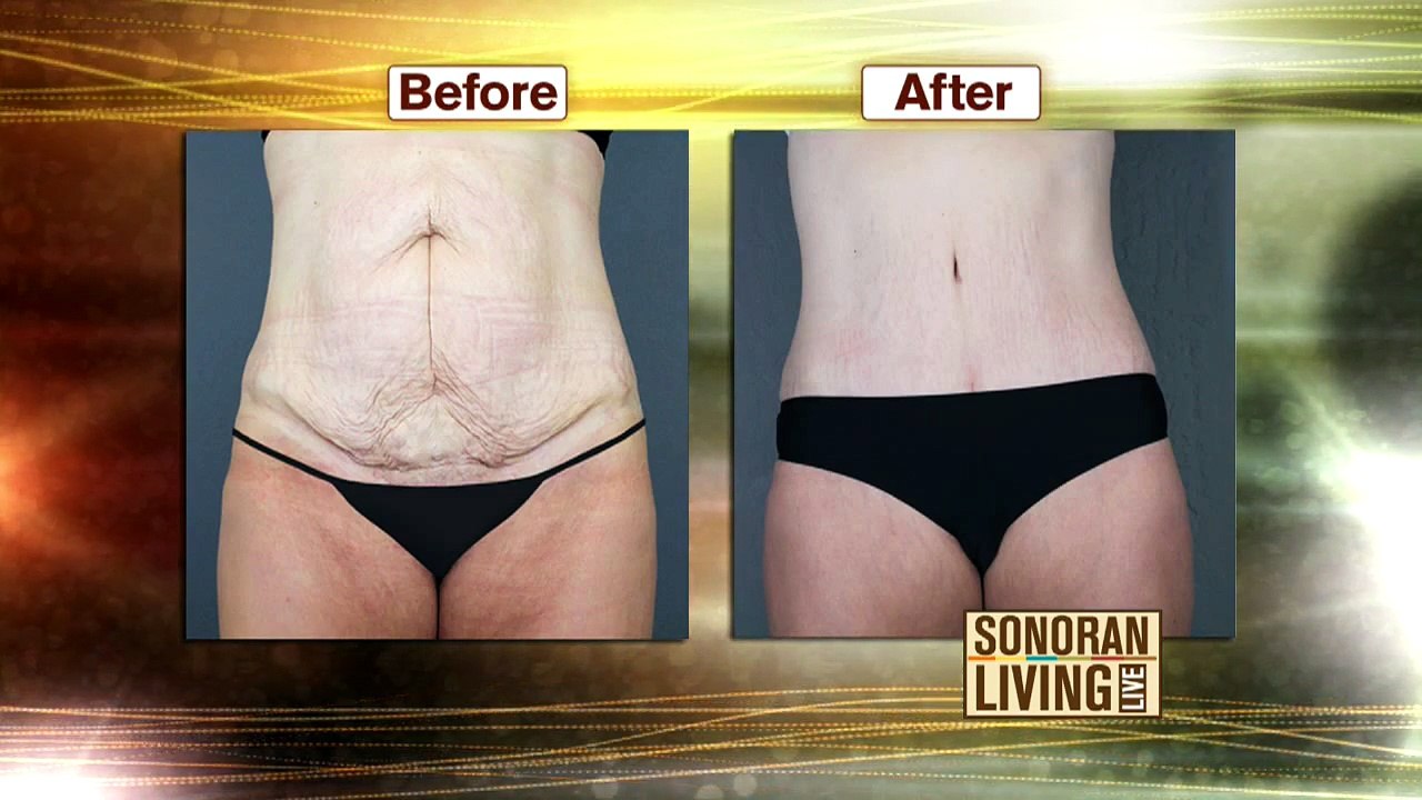 Tummy Tuck vs Liposuction