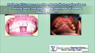 Dental Implant Tourism In India