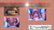 IMMEDIATE REPLACEMENT FOR MISSING UPPER MOLAR WITHOUT SINUS LIFT