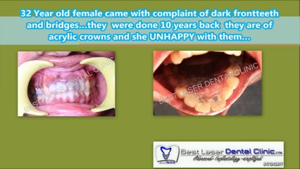 Smile Designing Cost in India