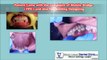 Smile Designing With Dental Implant for Cardiac Patient in India