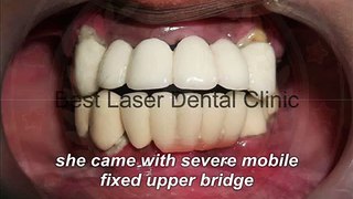 fixed teeth with basal implant without any bonegraft