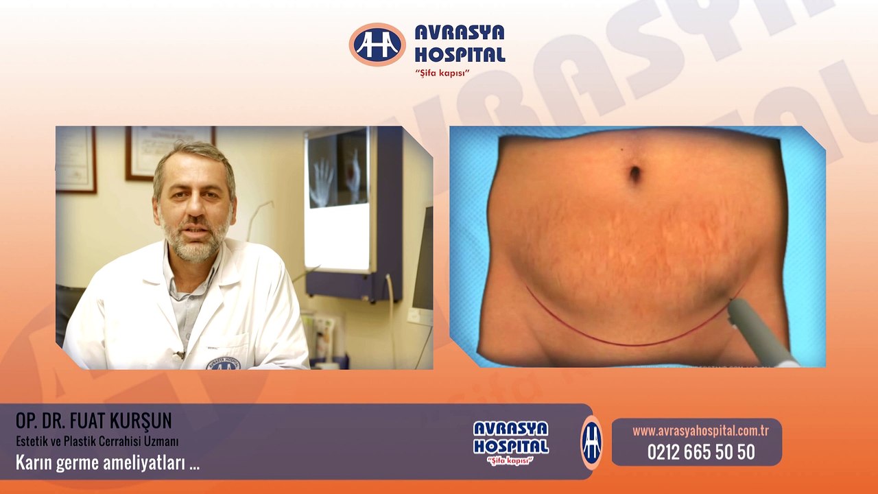 Op.Dr.Fuat Kurşun - Karın Germe Ameliyatlarını Anlatıyor..