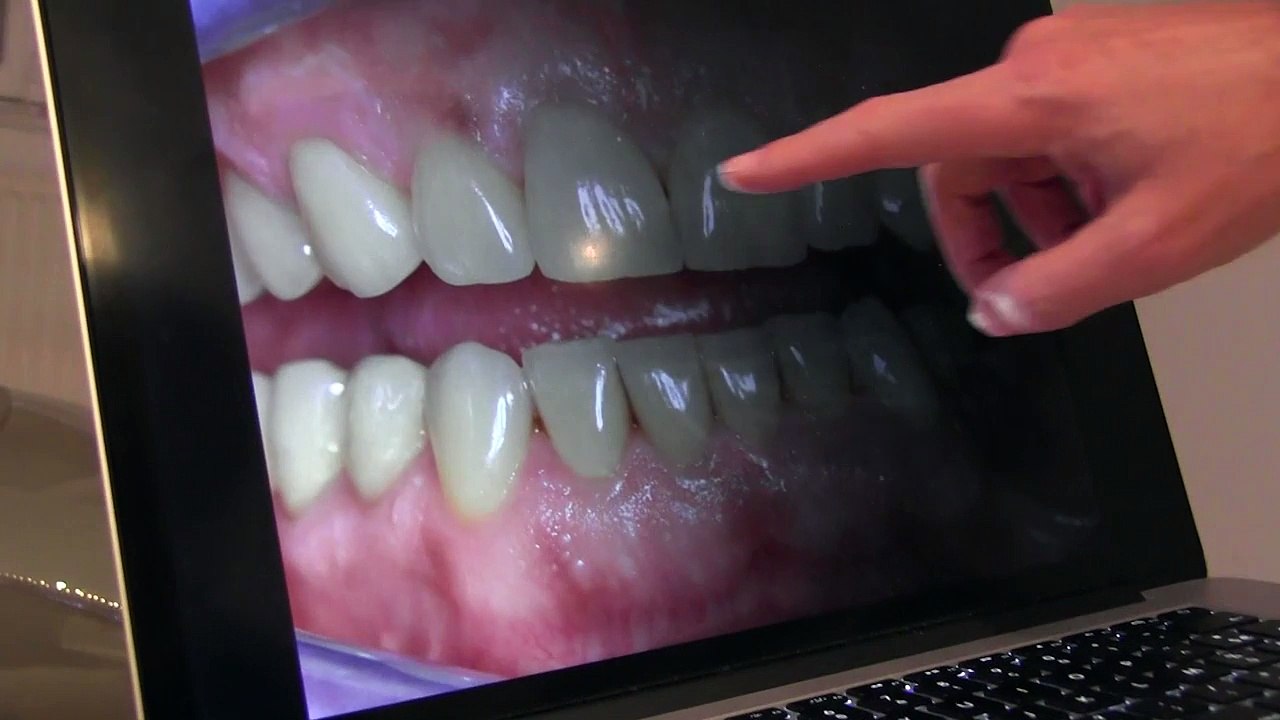 Dental Veneers / Facettes dentaires / Eric Hazan