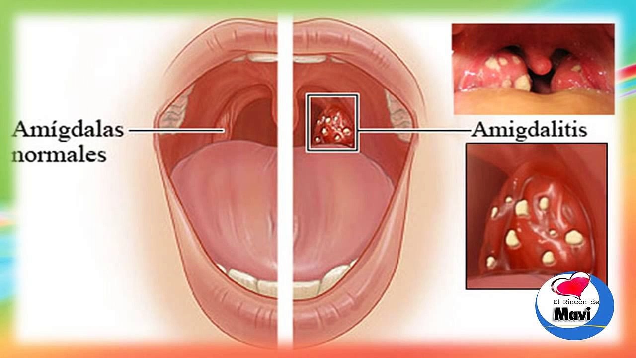 ¿Que es la amigdalitis_ - Sintomas - Remedios caseros para las anginas