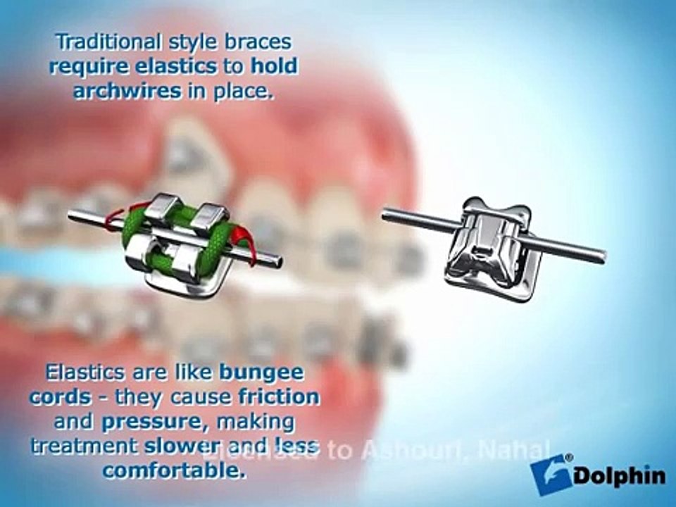 New System For Teeth Whitening