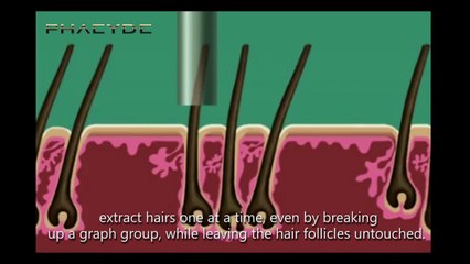 Hair Implant with the S.H.E. Hair Implant Method - PHAEYDE Clinic