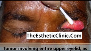 Eyelid Cancer | Sebaceous Gland Carcinoma | Cutler Beard Eyelid Flap Surgery - Dr. Debraj Shome