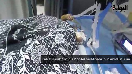 أطفال المنصورة" تنجح في فصل التوأم الملتصق "جنى وجودي" واستقرار حالتهم"