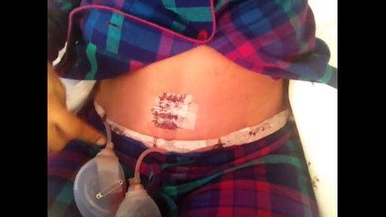 Next Day Visit From Doctor After Tummy Tuck Surgery