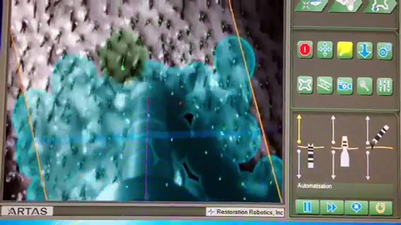 Démonstration implants capillaire avec le robot ARTAS par The Clinic Paris