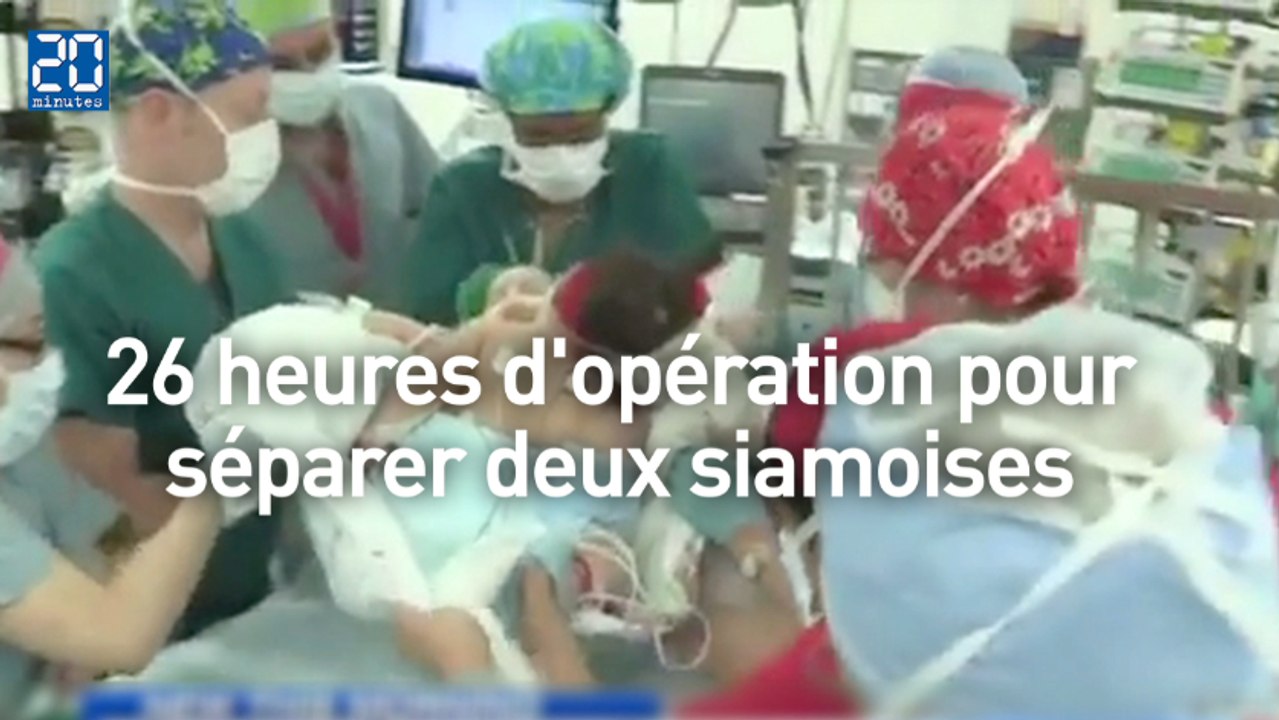 Séparation réussie pour deux siamoises jointes par le torse