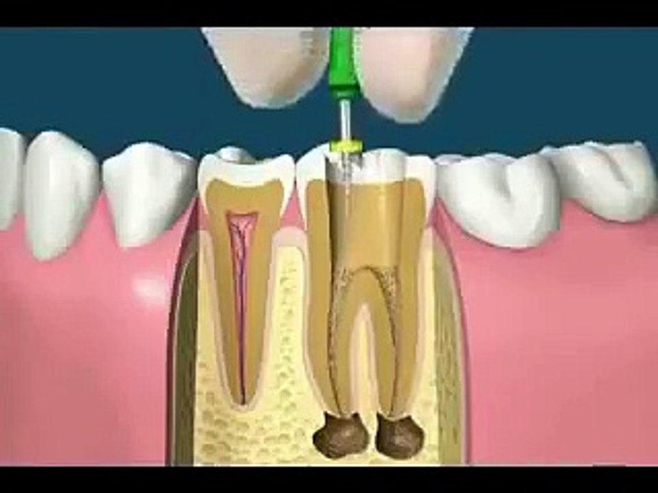 root canal