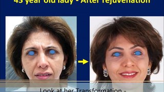 Facelift Surgery, Best Anti-Aging Wrinkle Treatment Rhytidectomy Mumbai India