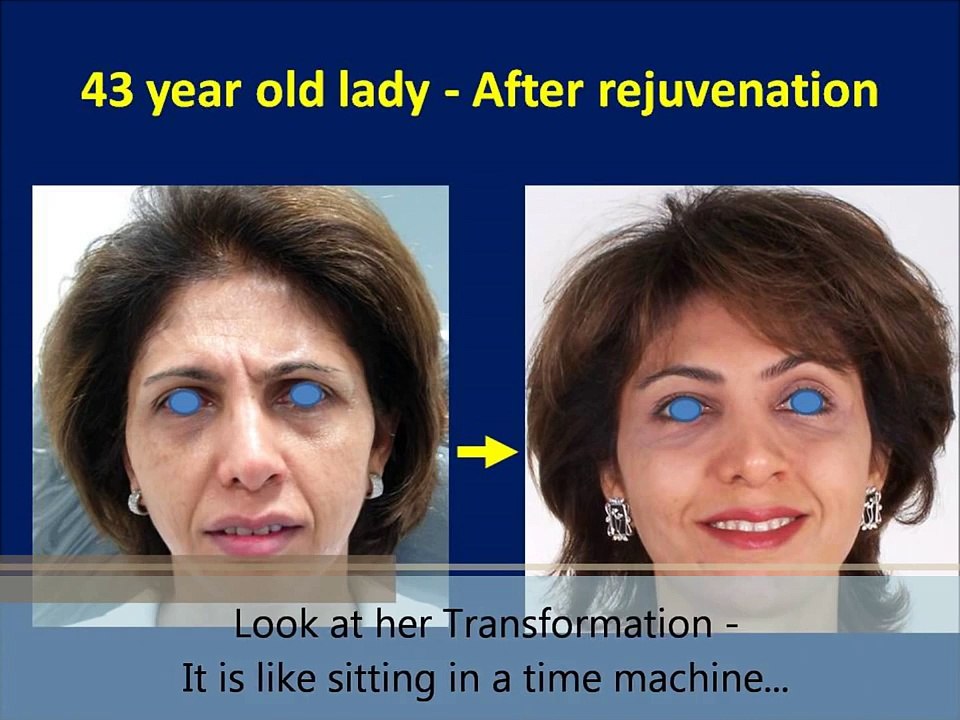 Facelift Surgery, Best Anti-Aging Wrinkle Treatment Rhytidectomy Mumbai India