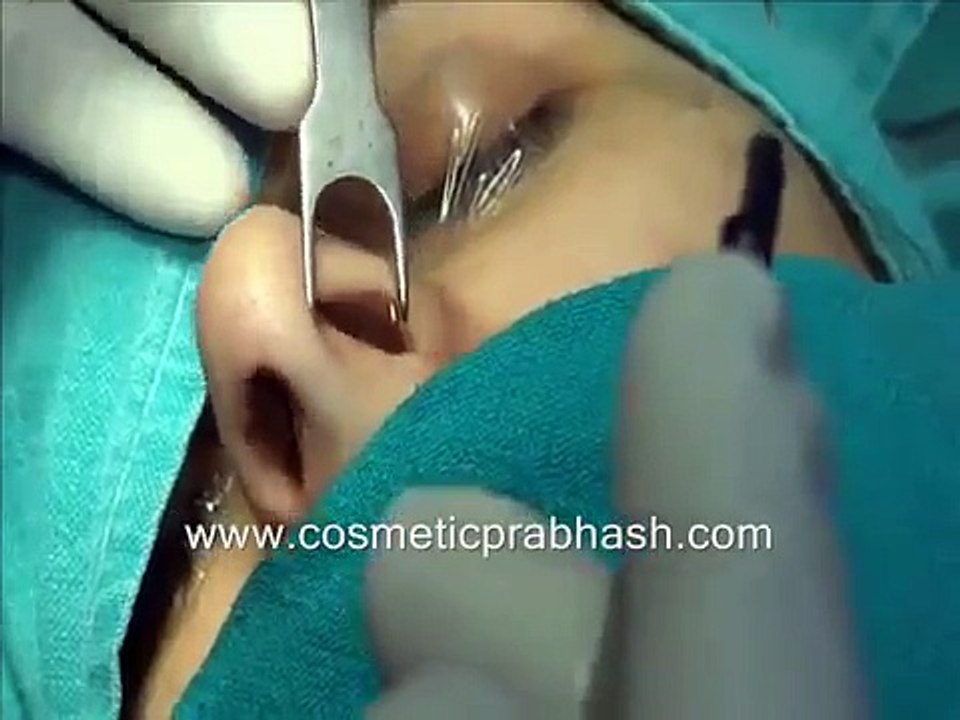 Rhinoplasty Delhi India Big Nose Dorsal Hump Reduction Surgery