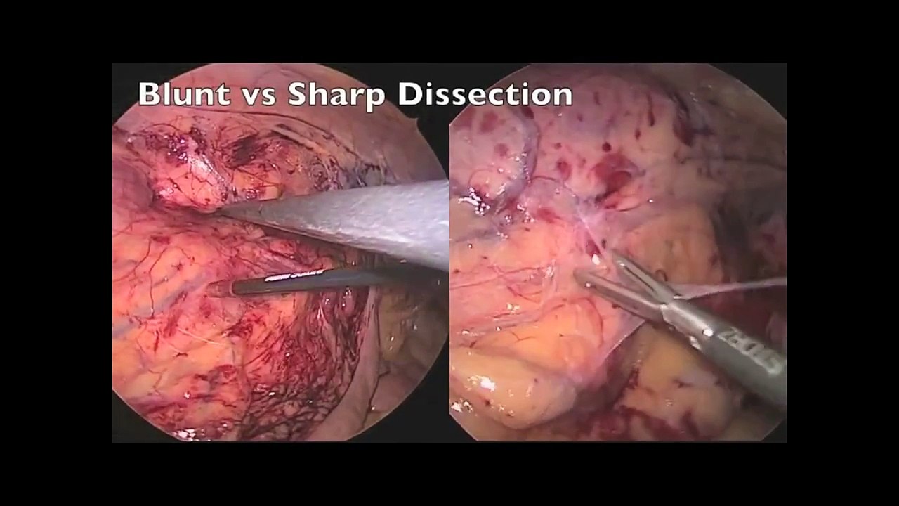 Evolution of Laparoscopic Donor Nephrectomy - Dr. Jim Hu | UCLA Urology
