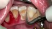 Détartrage de dents après 10 ans sans brossage de dent! Violent...