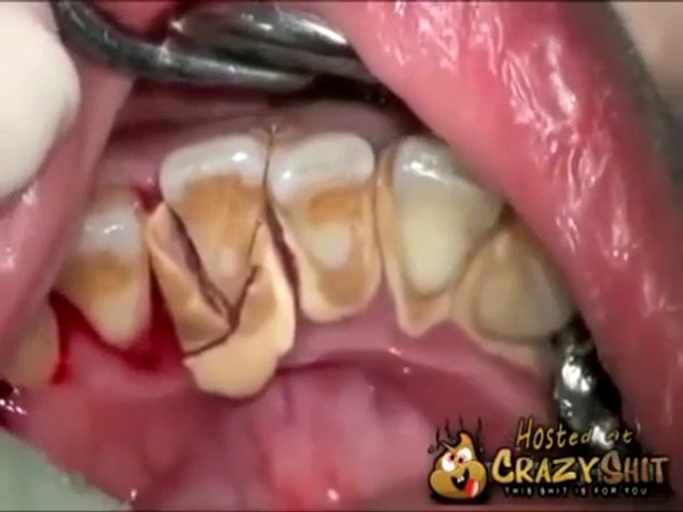 10 years without brushing teeth : violent Tooth scaling