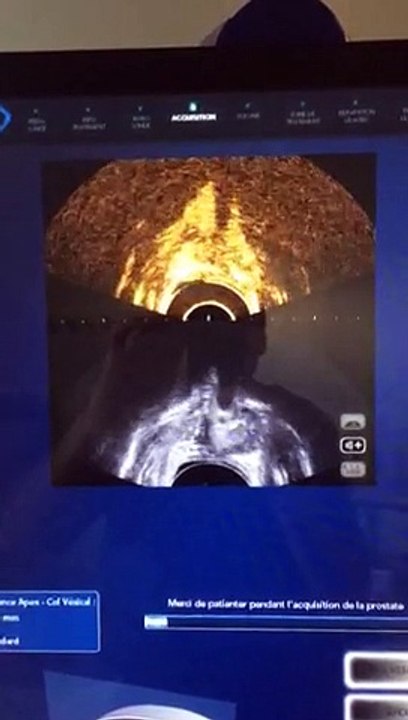 echographie de contraste apres traitement par ultrasons ( HIFU) pour un cancer localisé de la porstate
