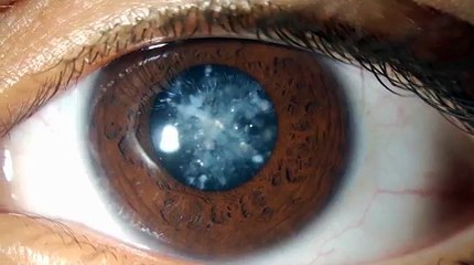 Protect Your Eyes From UV Damage Ask Our Eye Doctor In Calgary