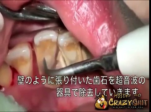 Horrible détartrage de dents