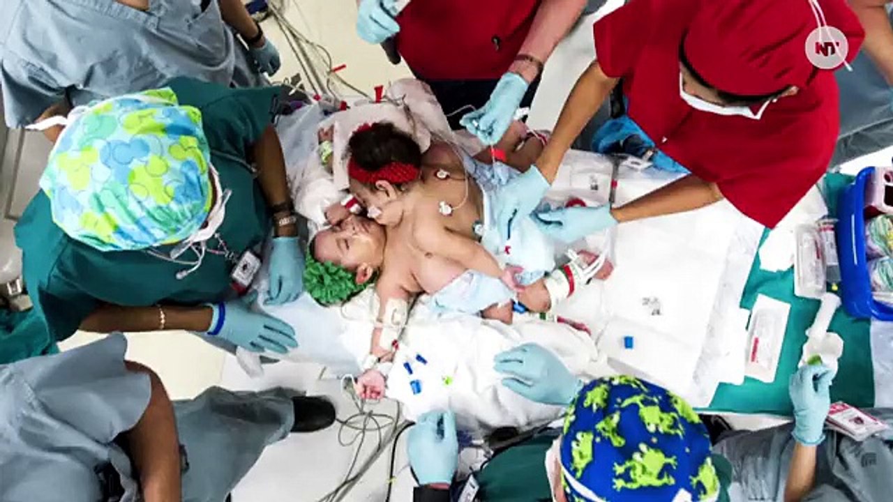 Conjoined Twins Successfully Separated In Unprecedented Surgery