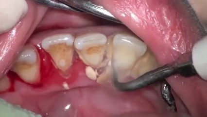 Extrême détartrage de dents