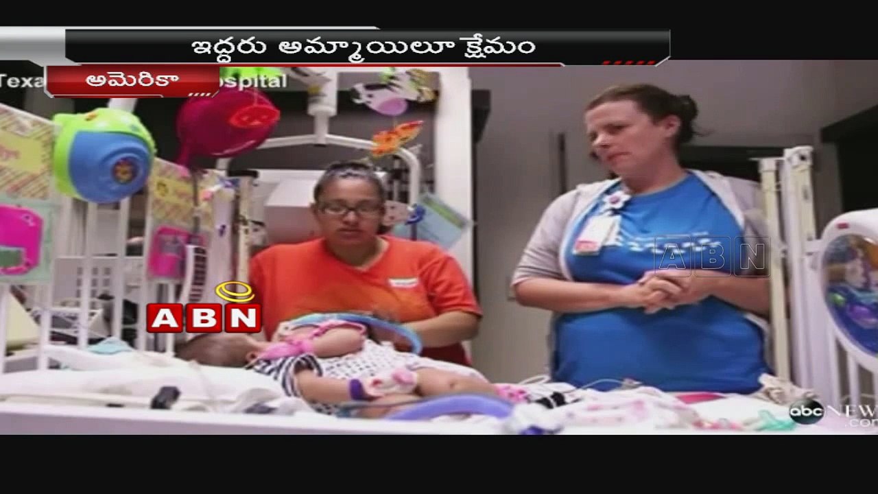 Conjoined Twins Successfully Separated At Texas Hospital - America