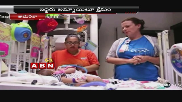 Conjoined Twins Successfully Separated At Texas Hospital - America