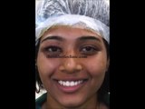 Ptosis Surgery (Eyelid Surgery) in Mumbai, India by Best Oculoplastic Surgeon - Dr. Debraj Shome