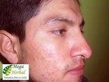 cura de acne rosacea remedio casero  medicina natural uriel tapia 94