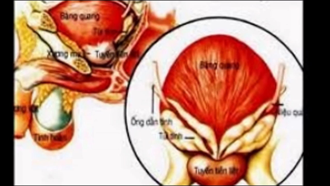 Nguyen nhan dau hieu trieu chung và chuan đoan ung thu tuyen tien liet