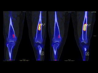 Une lésion osseuse diaphyo-metaphysaire calcifiee
