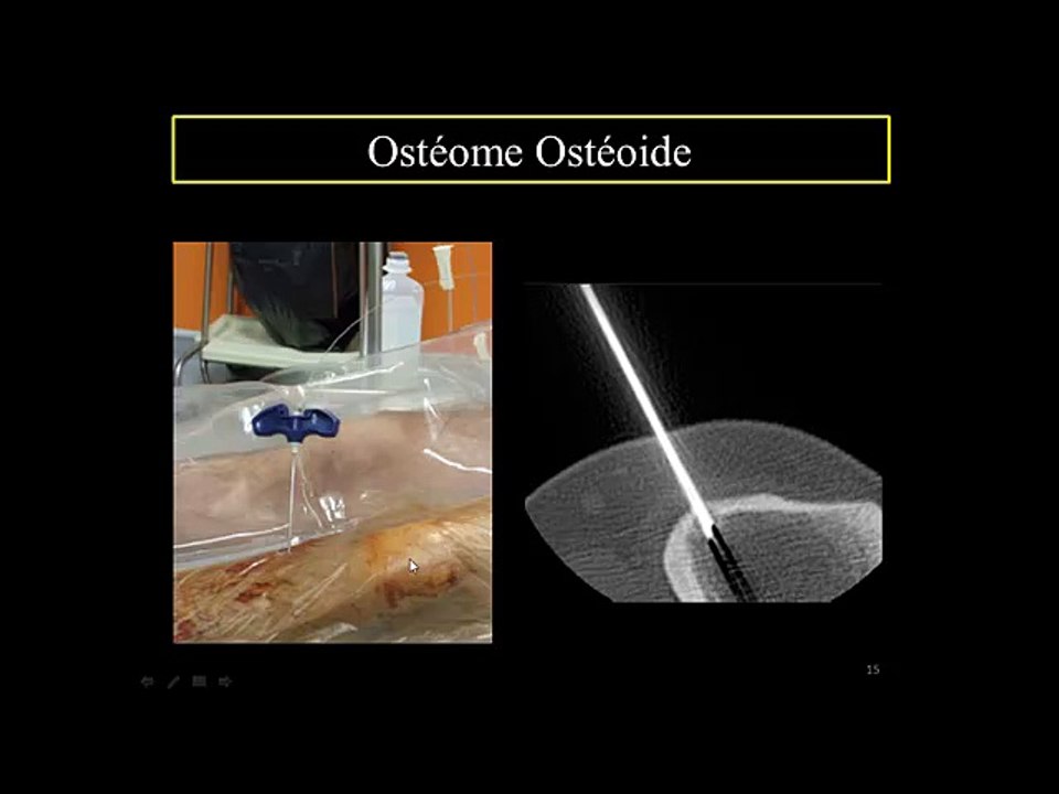 Tumeurs osseuses bénignes et biphosphonates
