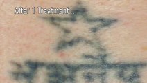 A Star Is Fading Away! Tattoo Removal