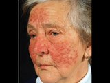 Skin Care - Rosacea - Natural Ayurvedic Home Remedies