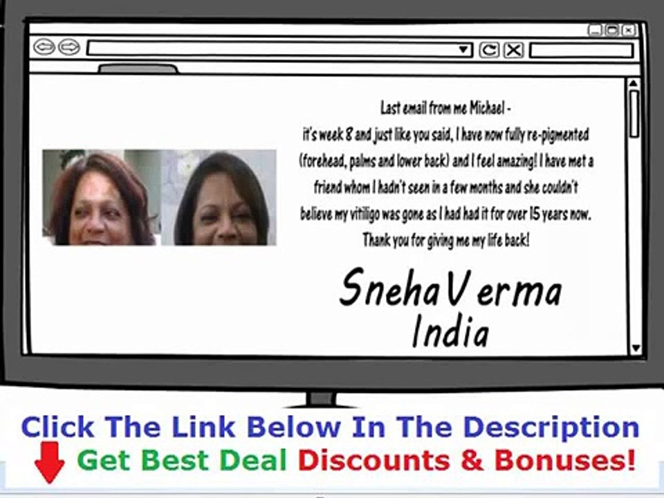 Natural Vitiligo Treatment System By Michael Dawson Reviews Discount + Bouns