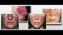 How I Healed Rosacea Naturally