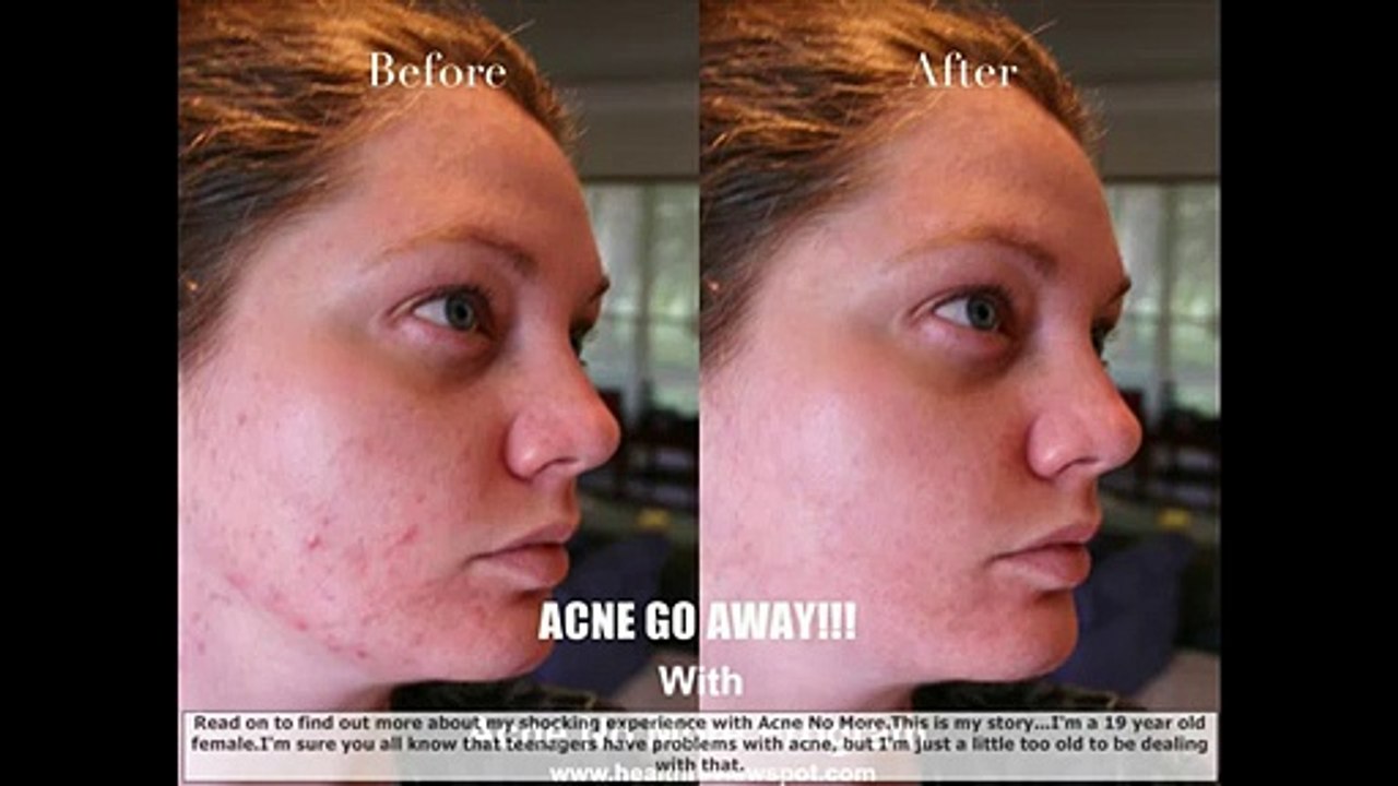 Discounted - Acne No More