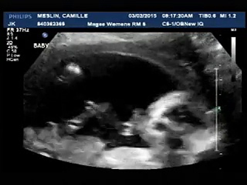 Echographie 18 semaines, Sylvain Jr