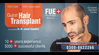 Correction of previous bad hair transplant or hair line correction by FUE hair transplant in Pakistan