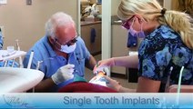 Single Tooth Implants - San Diego, CA - Dr. Peter Hellwig