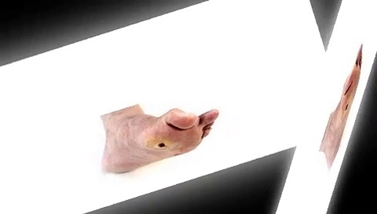 Pie diabetico sintomas - libre de diabetes