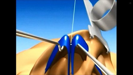 Rhinoplastie Tunisie