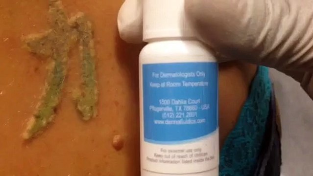 Fastest Way to Remove Tattoos with Laser!