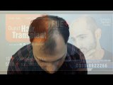 Hair transplant Clinic in Pakistan doing FUE hair transplant