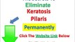 Keratosis Pilaris Treatment  Some Keratosis Pilaris Cure That Works - Living With Kp Review