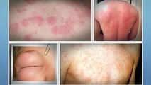 Get Rid Of Hives Review-How To Get Rid Of Hives Fast